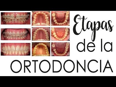 ETAPAS DE LA ORTODONCIA | FASES DEL TRATAMIENTO