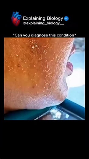Explaining Biology on Instagram: "Can you guess what’s REALLY happening to this skin? Most people think this is just dry skin, but the truth goes much deeper. This is excessive skin peeling, where dead skin cells shed faster than normal. Possible medical explanations include: • Severe xerosis (extreme dryness) • Exfoliative dermatitis • Seborrheic dermatitis • Dehydration and skin-barrier damage • Overuse of harsh skincare products Why does this happen? When the skin barrier breaks down, moistur