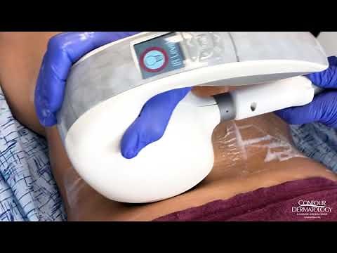 VelaShape Can Reshape and Reduce Cellulite | Contour Dermatology