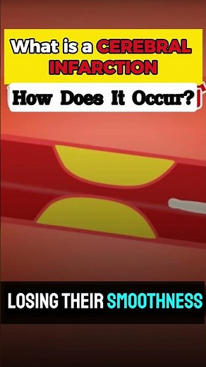 Cerebral Infarction: How It Starts and Why It Leads to Stroke