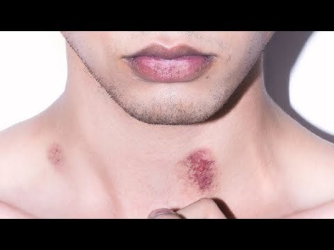 HOW TO GET RID OF A HICKEY NATURAL RESULTS