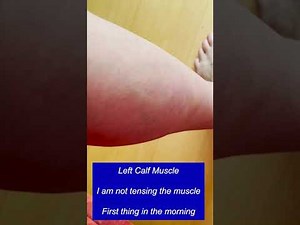 😲MY MUSCLE FASCICULATION😲 #Shorts #muscles