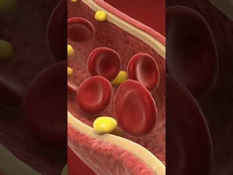 Endovascular Celiac Artery Stenting Explained | A Rare Intestinal Blood Vessel Procedure