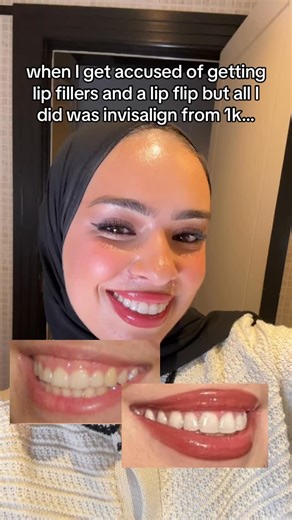Dr Soumaya Zinet 💍 on Instagram: "NEW YEAR, NEW INSANE INVISALIGN OFFER FOR THIS MONTH 🥳🎉 GUYS DON’T MISS OUT!! For the first 50 patients this month you can start Invisalign from LESS than £30 a month!! 🚨 We’re talking about: ✅ The LOWEST Invisalign price anyone has seen!! ✅ FREE whitening ✅ Every case is specialist orthodontist approved ✅ You will see your smile BEFORE you start!! AND… IN ORDER TO MAKE SURE YOU ALWAYS GET THE LOWEST INVISALIGN PRICE FOR THE BEST EXPERIENCE… I will ALWAYS of
