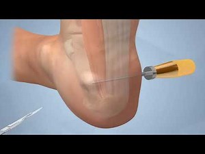 Stryker EPF - Endoscopic Plantar Fasciotomy