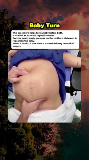 How Doctors Turn a Baby Before Birth #curiosity #mistery