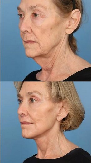 Neck Lift 101: Introduction to Advanced Techniques | Part 1 #NeckLift