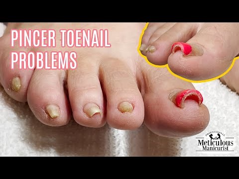 Pedicure Tutorial on Pincer Toenails that Cause Pain
