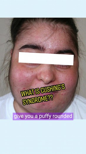 Understanding Cushing’s Syndrome: Signs, Symptoms, Causes & Treatment
