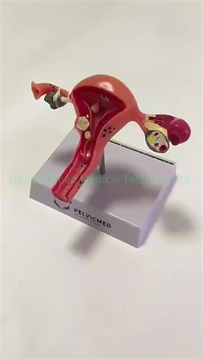 Female Uterus Pathological Anatomical Model Uterine Disease Anatomy Education Model