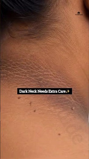 Dark Neck? Try This Gentle DIY Neck Care Routine ✨Easy Neck Care at Home