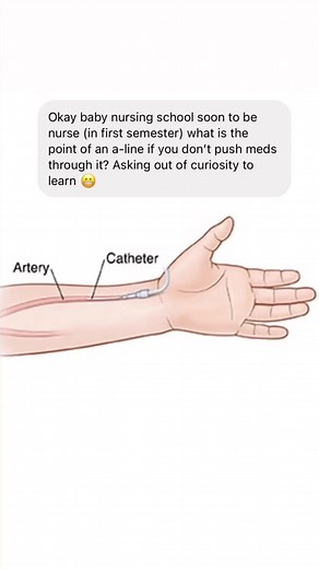 Understanding Arterial Lines in ICU Settings