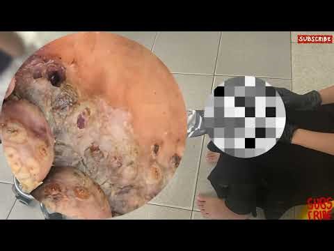 Extreme Jigger Infestation – Unexpected Deep Tissue Impact! #VS376