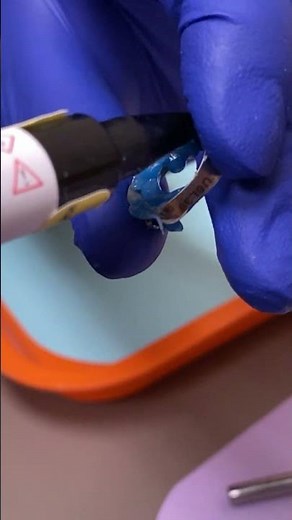 Loose Molar Band - Molar Bands Pain - Tooth Time Family Dentistry New Braunfels Texas