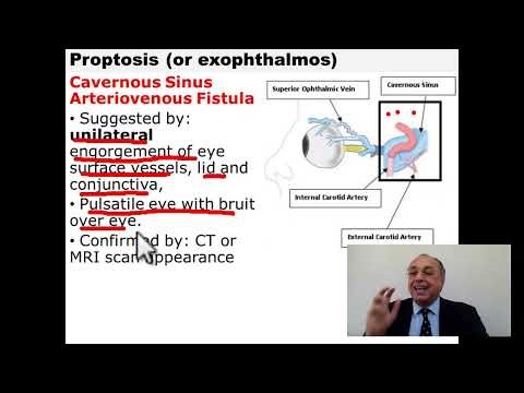 Exophthalmos (Clinical Diagnosis) [Part 5]