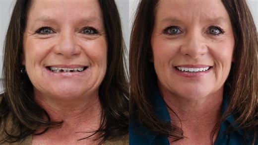 Dental implants vs. dentures: Why more patients are making the switch