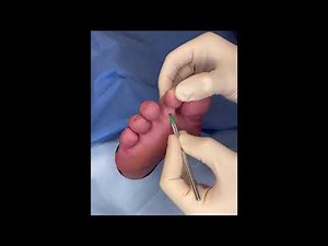 Foot & Ankle Orthopaedics - MIS Plantar Capsule Release & Tenotomy for Rigid Diabetic Hammertoe