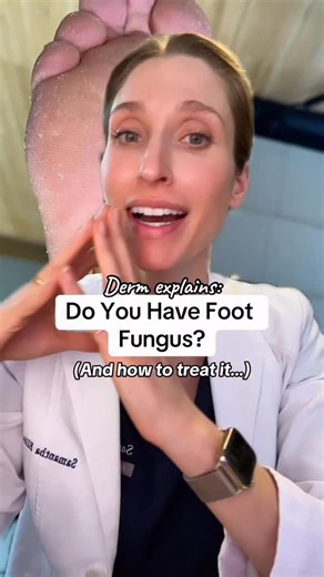 Sam Ellis, MD, FAAD | Dermatologist on Instagram: "It’s not dry skin, and it’s SO easy to treat🦶 #athletesfoot #dryfeet #footfungus #dermatology #podiatry"