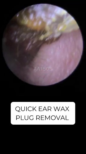 Satisfying Ear Wax Plug Removal | Audiology Procedure