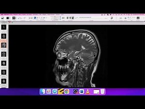 MRI BRAIN REPORTING- ARACHNOID CYST