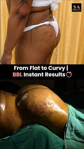 From Flat to Curvy | BBL Instant Results🍑