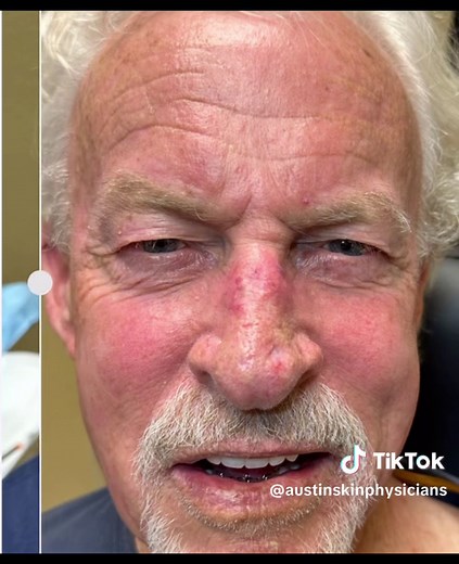 5-Fluorouracil Cream for Skin Cancer Treatment