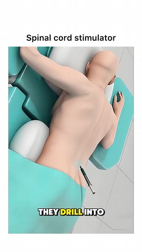 Animations | Follow @surgicalanimation for more! 🏥 | Instagram