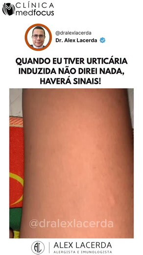 Dr. Alex Lacerda - Alergista e Imunologista UNIFESP-EPM on Instagram: "Conhece alguém que fica assim? 😱 As urticárias induzidas correspondem a um grupo de urticárias em que as lesões ou sintomas surgem com estímulos específicos — térmicos, mecânicos, vibratórios, aquáticos ou relacionados à pressão. Nessas condições, o estímulo externo desencadeia a liberação de mediadores pelos mastócitos cutâneos, resultando na formação de pápulas, eritema e prurido. 👉 Entre elas, o dermografismo (ou urticár
