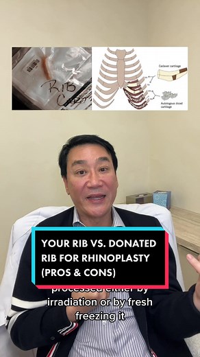 Replying to @browniedooooo Using your own rib vs. donated rib for rhinoplasty. Let’s talk pros and cons. #ribrhinoplasty #nosejob #rhinoplasty #plasticsurgery #plasticsurgeon #trending