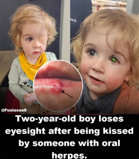 Asaa Fusi on Instagram: "A simple kiss led to a life-altering injury for a toddler who had no way to understand what was happening. In 2017, a two-year-old boy in the UK contracted herpes simplex virus type 1 after being kissed by an adult with an active cold sore. The virus spread to his eye, causing herpes simplex keratitis—a rare but serious condition in young children. At first, doctors thought it was a routine eye infection, but the virus kept damaging his cornea. Despite months of antivira