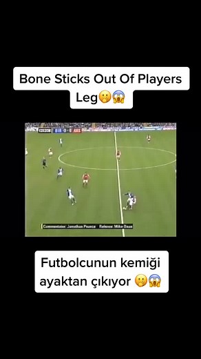 Terrifying Football Injury: Bone Sticks Out Of Player's Leg
