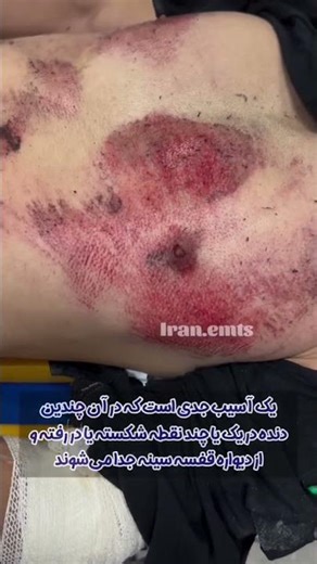 قفسه سینه شناور چیست؟ | مکانیسم تنفس پارادوکسیکال در شکستگی دنده