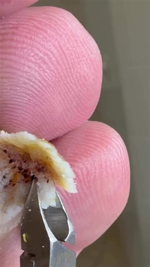 Comprendre les verrues plantaires : causes et traitements