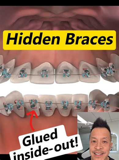 Braces on the Inside? Everything You Need to Know About Lingual Braces #dentallan #dentist #braces #orthodontics #straightteeth