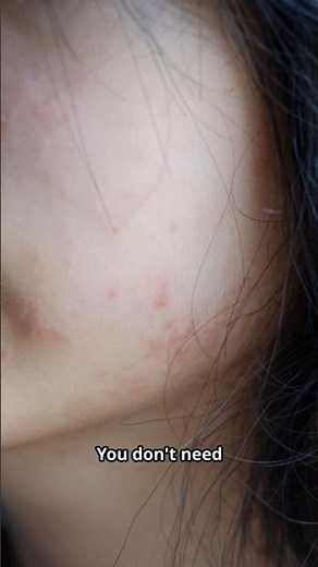 Stop Fungal Rash Fast — No Doctor Needed