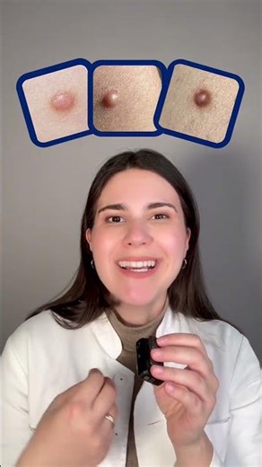 ATTENTION! - Mole or dermatofibroma?