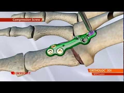 ORTHOLOC™ 3Di Foot Reconstruction System MTP Fusion Plate Animation