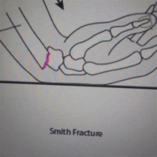Orthopedics: Colles Fracture Vs Smith Fracture