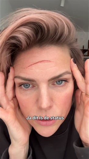 Tamara Brinkman on Instagram: "Status update #ongelukje #kat #litteken #skincare #witlof"