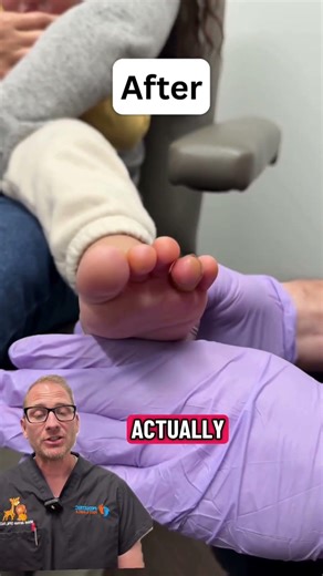 Kids’ Hammertoes: Before & After In-Office Correction