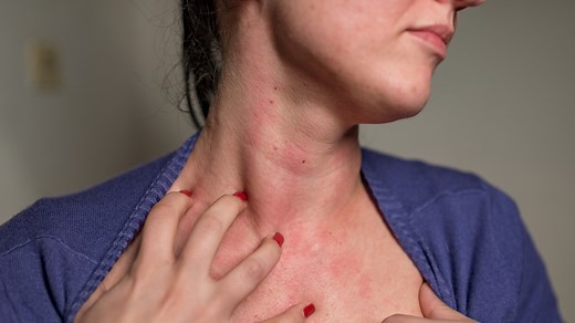 A Skin Rash on Your Neck May Be a Sign of Poor Thyroid Health: What Signs and Symptoms to Look For