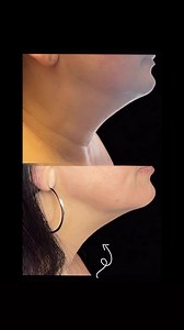 Flat 30%off  #Radiofrequency is a noninvasive minimal downtime...