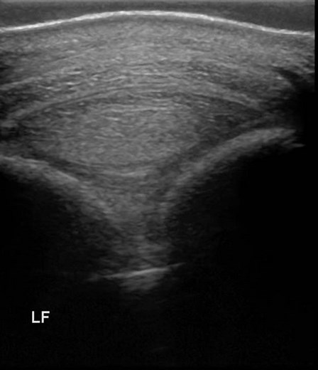 Ultrasound of palmar annular ligament