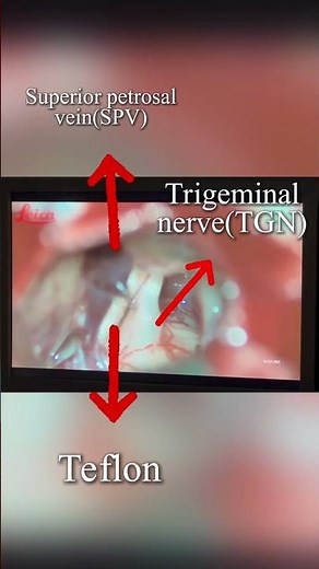 Microsurgical Trigeminal Neuralgia Surgery | Microvascular Decompression (MVD) with Teflon Implant