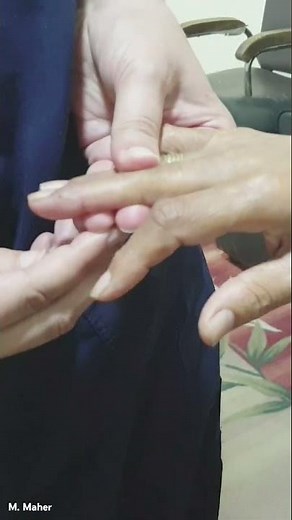 Positive Hoffmann's sign