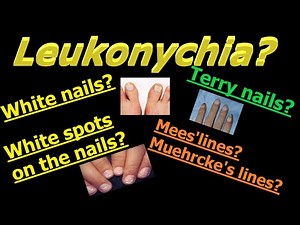 All about Leukonychia/ whitening of the nails