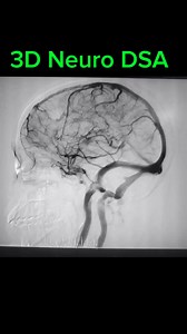 3D Neuro DSA 360° #MRI #radiologystudent #medicaltechnologist #xraytechnologist #anatomy #mritechnologist #mritech #xray #MedicalTech #ctscan #medicaltechnology #radiography #radiologist #medical #medicalimaging #radiologyresident #radiology #DiagnosticImaging #radiologytechnologist #doctor #xraytech #radiologytech #radiologylife #medicalstudent #radiologia #radtech #angiogram#angiogramacerebral #Digitalsubtra#digitalsubtractionangiography #digitalsubtractionangiogram | Maruf Bhuiyan The Radiogr