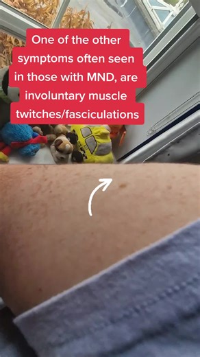 Understanding MND Symptoms: Muscle Twitches and Fasciculations