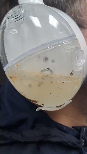 40 million Americans experience earwax buildup every year. Let’s change that with OtoSet