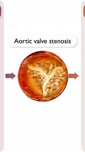 🌟 The latest State-of-the-Art review on Calcific Aortic Stenosis: Omics-Based Target Discovery and Therapy Development just published in the European Heart Journal (EHJ) 📚🔬 This comprehensive review explores cutting-edge multi-omics approaches (including genomics, transcriptomics, proteomics, and metabolomics) to uncover new therapeutic targets for aortic stenosis. 🧬🧪 🔍 - Innovative Research : Unveils the complex mechanisms driving calcific aortic stenosis and identifies potential drug tar